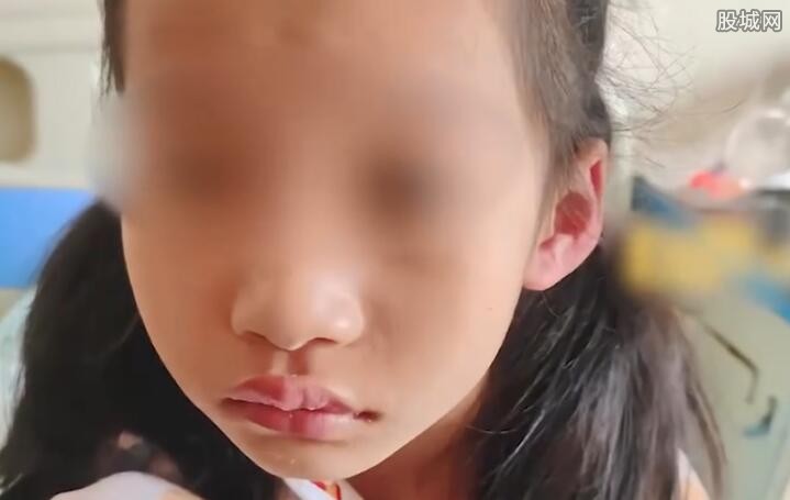 6岁女童吃瑞士卷引起头孢过敏（导致全身红肿）