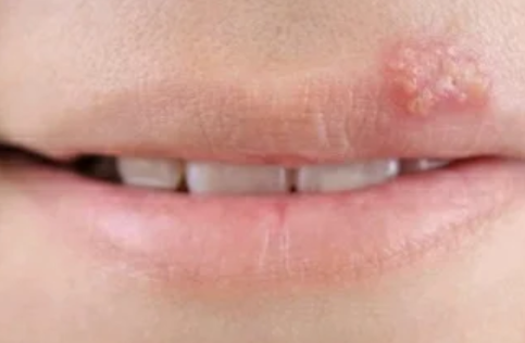 嘴角疱疹牙龈会肿吗（疱疹和上火水泡的区别）