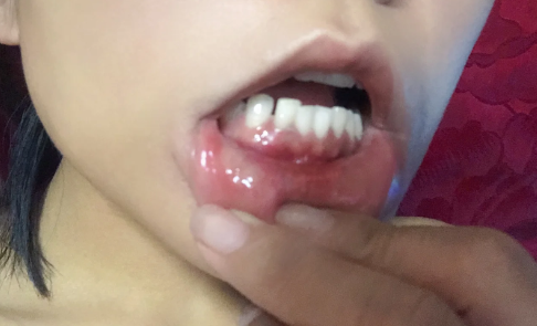 牙龈也会口腔溃疡吗（牙龈长口腔溃疡正常吗）
