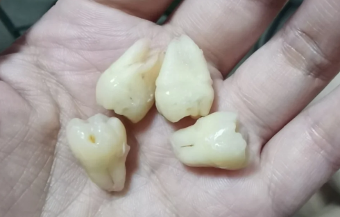 为什么有的牙齿有2个牙根有的没有（智齿有几个牙根）